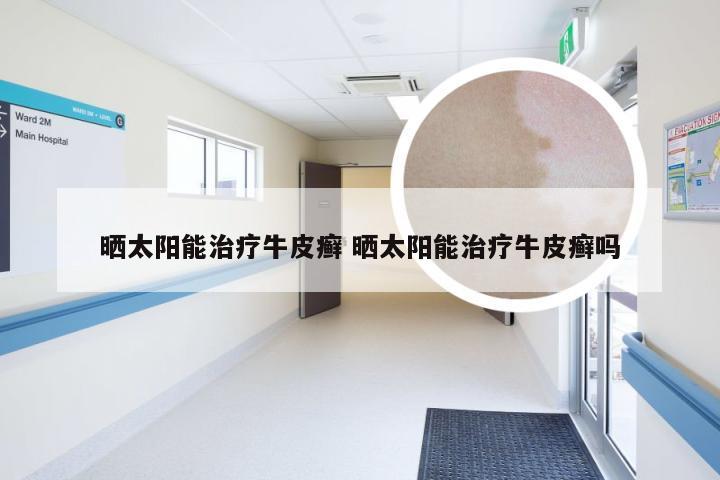 晒太阳能治疗牛皮癣 晒太阳能治疗牛皮癣吗