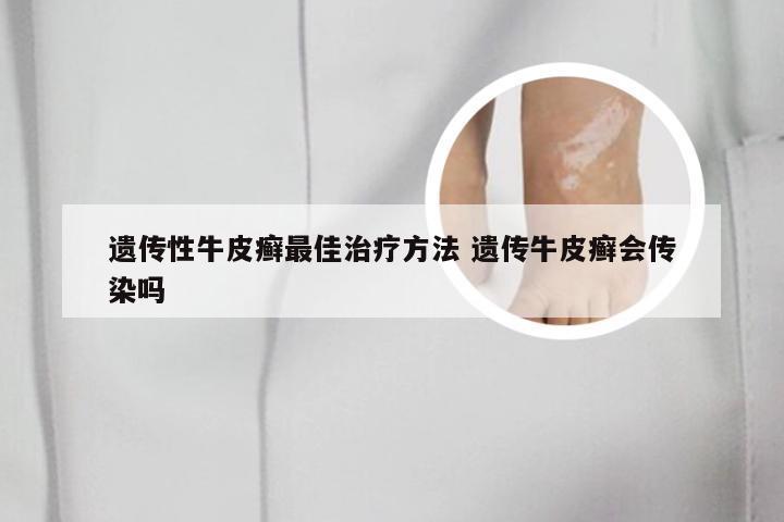遗传性牛皮癣最佳治疗方法 遗传牛皮癣会传染吗