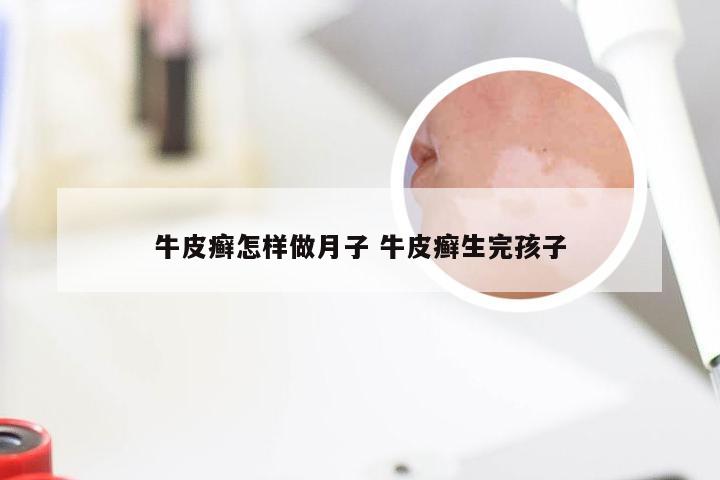 牛皮癣怎样做月子 牛皮癣生完孩子