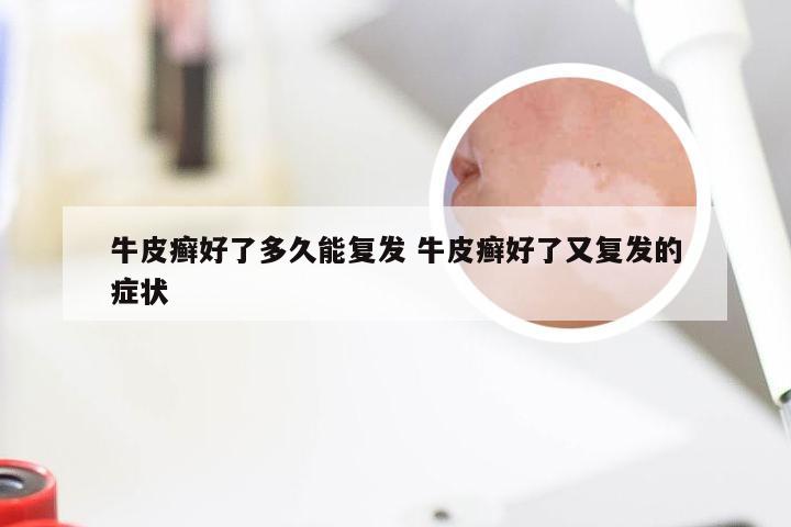 牛皮癣好了多久能复发 牛皮癣好了又复发的症状