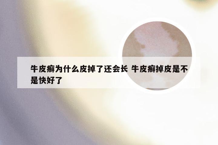 牛皮癣为什么皮掉了还会长 牛皮癣掉皮是不是快好了