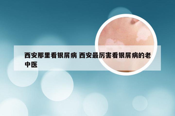 西安那里看银屑病 西安最厉害看银屑病的老中医