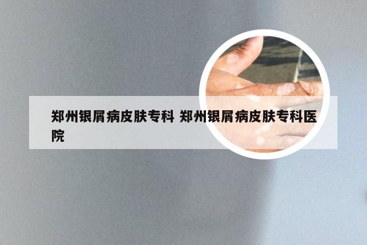 郑州银屑病皮肤专科 郑州银屑病皮肤专科医院