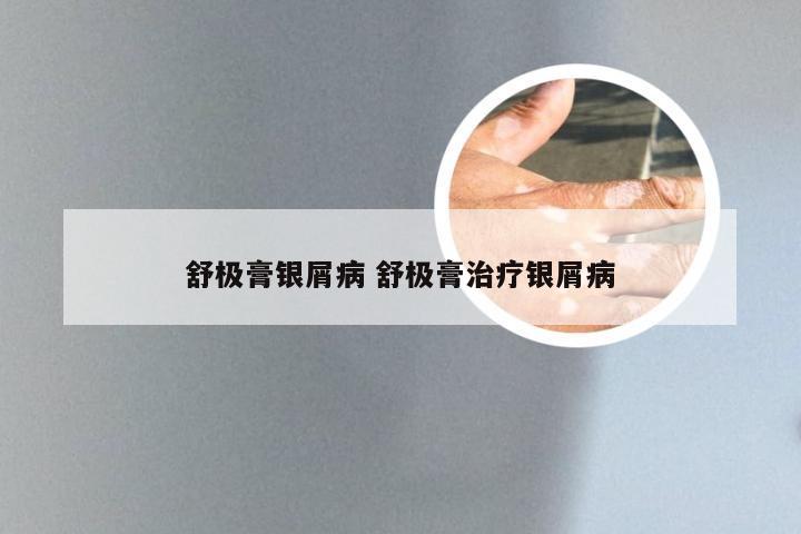 舒极膏银屑病 舒极膏治疗银屑病