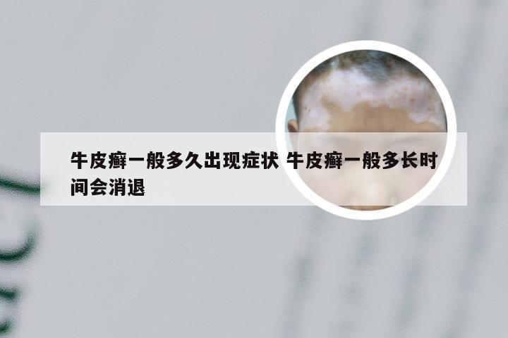 牛皮癣一般多久出现症状 牛皮癣一般多长时间会消退