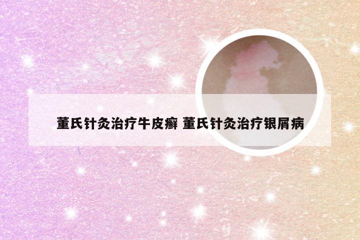 董氏针灸治疗牛皮癣 董氏针灸治疗银屑病