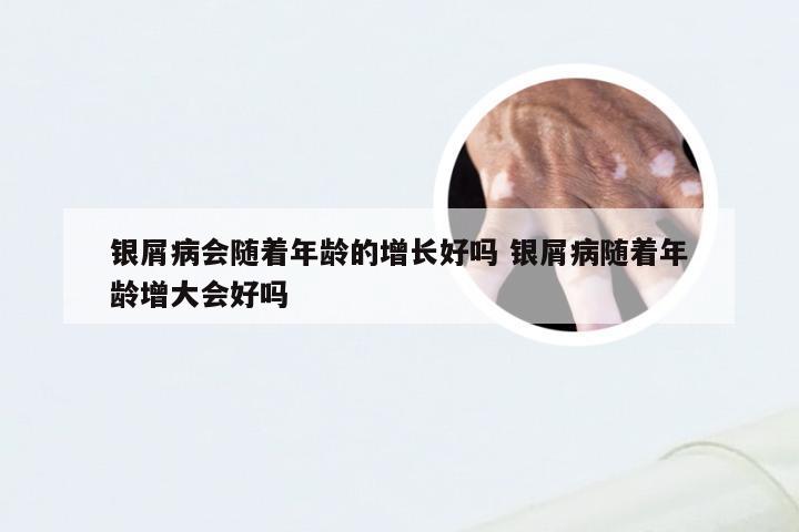 银屑病会随着年龄的增长好吗 银屑病随着年龄增大会好吗