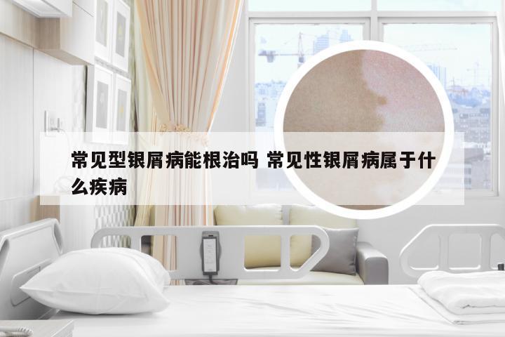 常见型银屑病能根治吗 常见性银屑病属于什么疾病