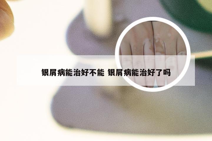 银屑病能治好不能 银屑病能治好了吗