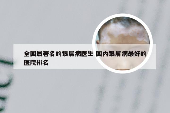 全国最著名的银屑病医生 国内银屑病最好的医院排名