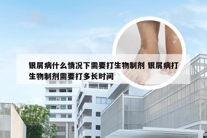 银屑病什么情况下需要打生物制剂 银屑病打生物制剂需要打多长时间