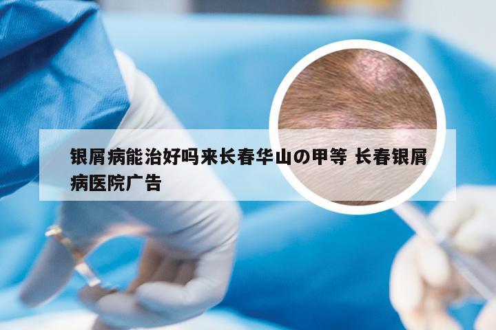 银屑病能治好吗来长春华山の甲等 长春银屑病医院广告