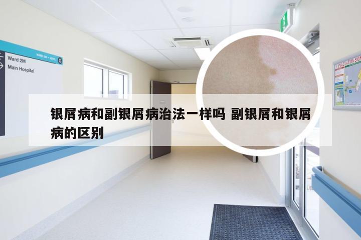 银屑病和副银屑病治法一样吗 副银屑和银屑病的区别