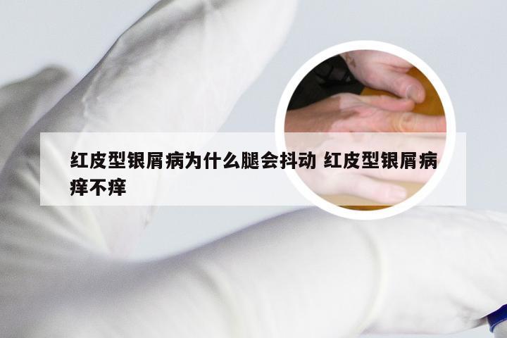 红皮型银屑病为什么腿会抖动 红皮型银屑病痒不痒