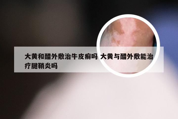 大黄和醋外敷治牛皮癣吗 大黄与醋外敷能治疗腱鞘炎吗