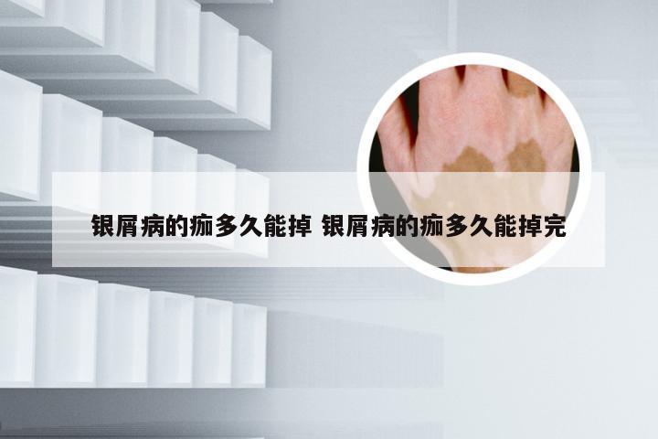 银屑病的痂多久能掉 银屑病的痂多久能掉完