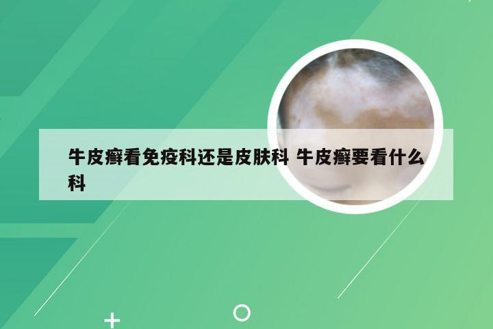 牛皮癣看免疫科还是皮肤科 牛皮癣要看什么科