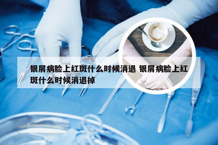 银屑病脸上红斑什么时候消退 银屑病脸上红斑什么时候消退掉