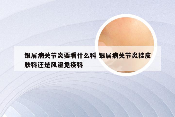 银屑病关节炎要看什么科 银屑病关节炎挂皮肤科还是风湿免疫科