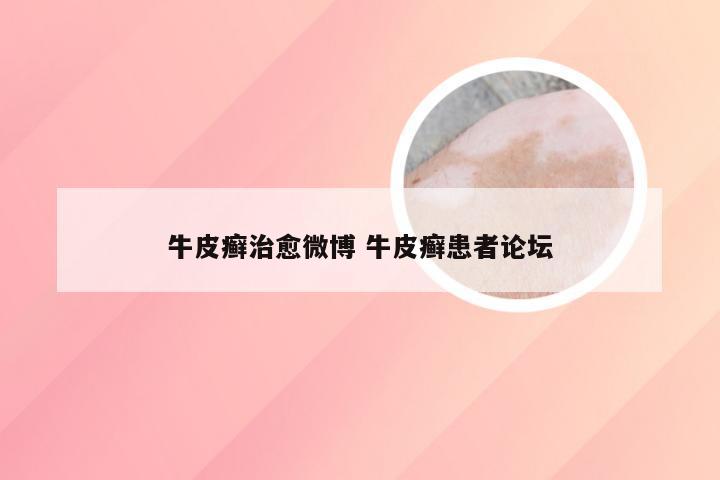 牛皮癣治愈微博 牛皮癣患者论坛