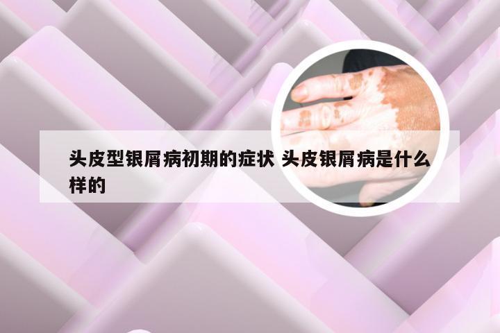 头皮型银屑病初期的症状 头皮银屑病是什么样的