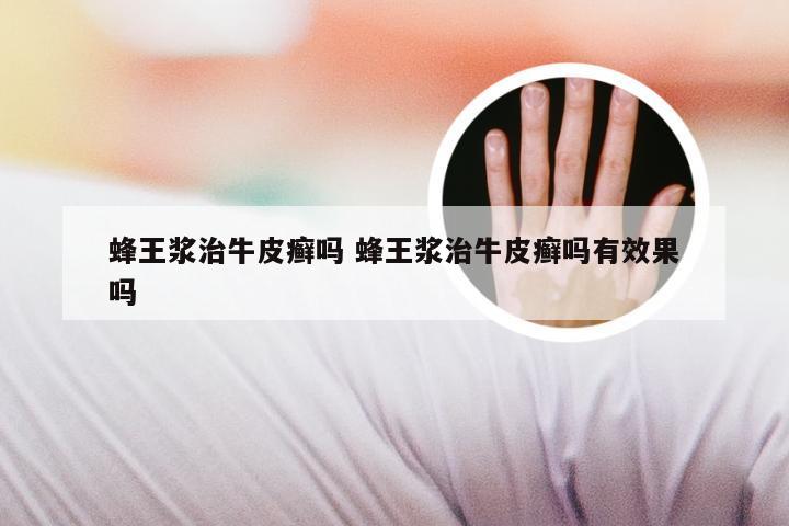 蜂王浆治牛皮癣吗 蜂王浆治牛皮癣吗有效果吗