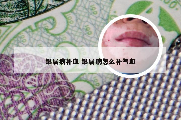 银屑病补血 银屑病怎么补气血
