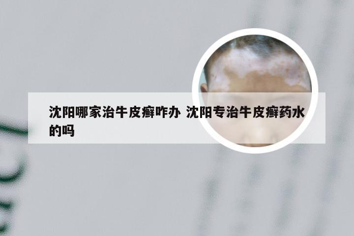 沈阳哪家治牛皮癣咋办 沈阳专治牛皮癣药水的吗