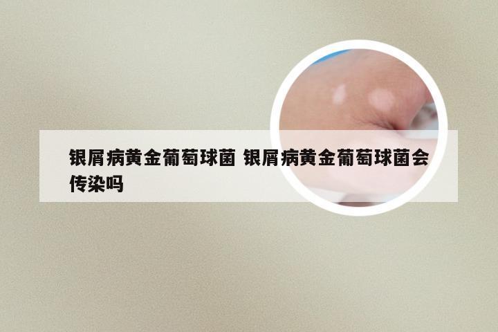 银屑病黄金葡萄球菌 银屑病黄金葡萄球菌会传染吗