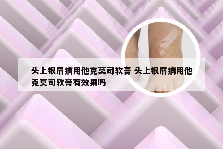 头上银屑病用他克莫司软膏 头上银屑病用他克莫司软膏有效果吗