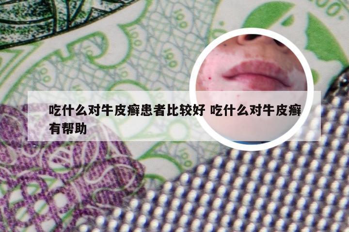 吃什么对牛皮癣患者比较好 吃什么对牛皮癣有帮助