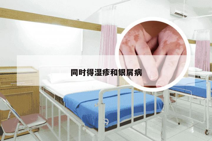 同时得湿疹和银屑病