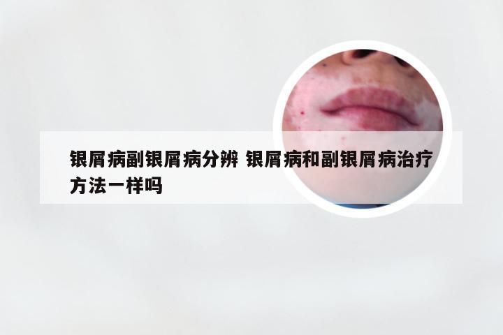 银屑病副银屑病分辨 银屑病和副银屑病治疗方法一样吗