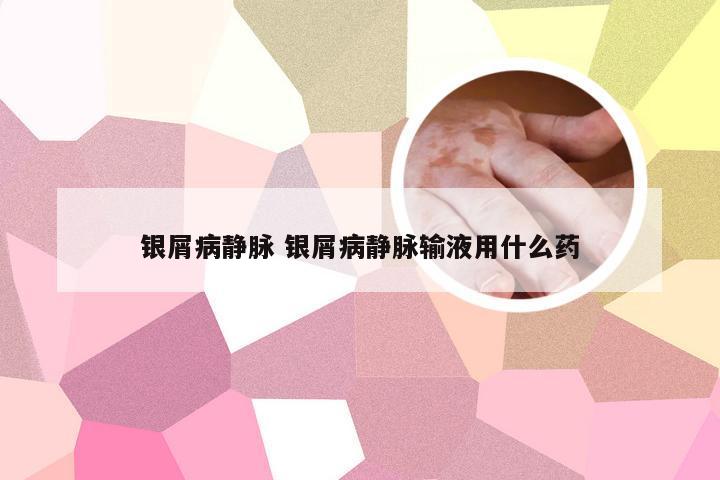 银屑病静脉 银屑病静脉输液用什么药