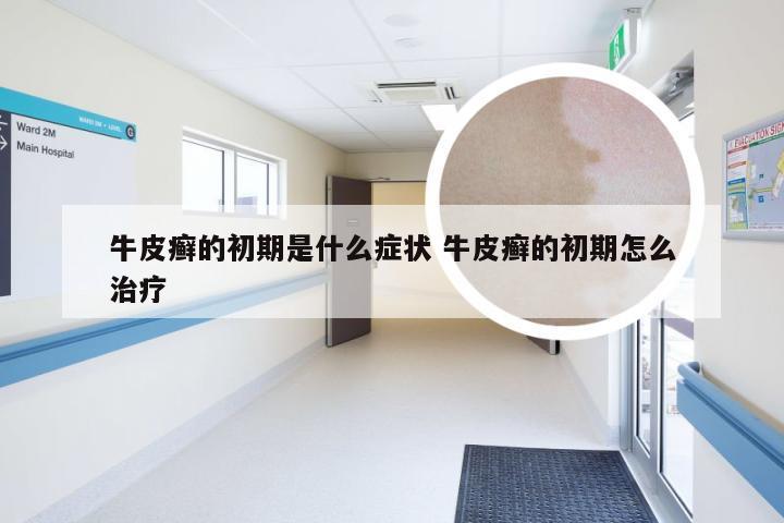 牛皮癣的初期是什么症状 牛皮癣的初期怎么治疗