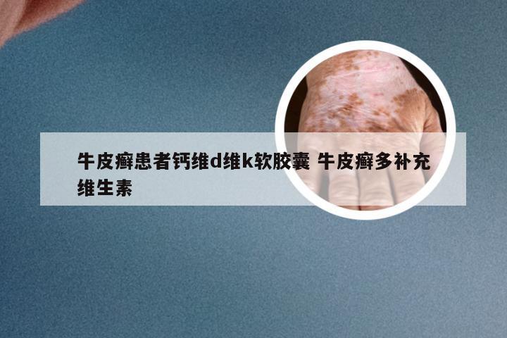 牛皮癣患者钙维d维k软胶囊 牛皮癣多补充维生素