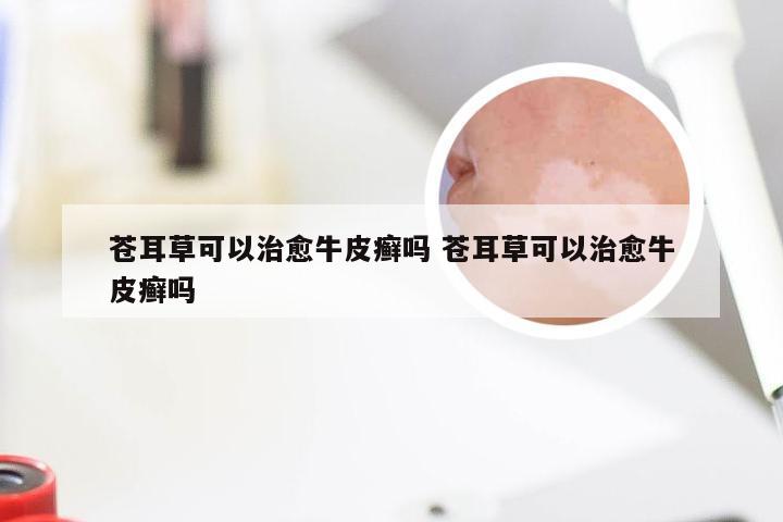 苍耳草可以治愈牛皮癣吗 苍耳草可以治愈牛皮癣吗