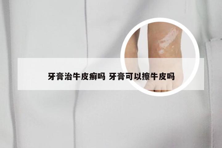 牙膏治牛皮癣吗 牙膏可以擦牛皮吗