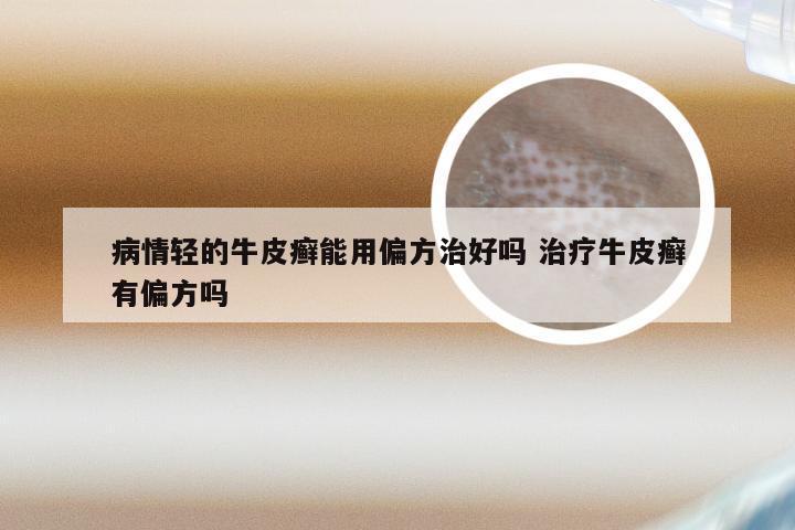 病情轻的牛皮癣能用偏方治好吗 治疗牛皮癣有偏方吗