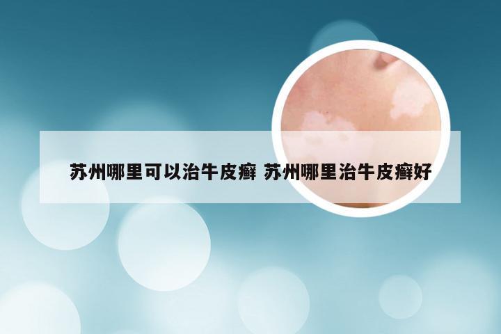 苏州哪里可以治牛皮癣 苏州哪里治牛皮癣好
