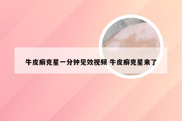 牛皮癣克星一分钟见效视频 牛皮癣克星来了