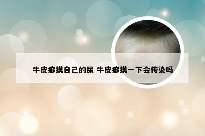 牛皮癣摸自己的尿 牛皮癣摸一下会传染吗