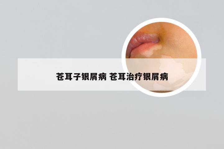 苍耳子银屑病 苍耳治疗银屑病