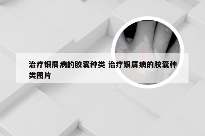 治疗银屑病的胶囊种类 治疗银屑病的胶囊种类图片