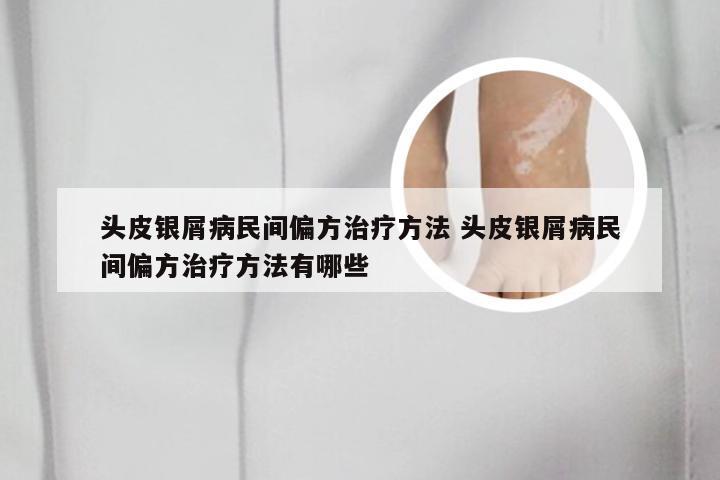 头皮银屑病民间偏方治疗方法 头皮银屑病民间偏方治疗方法有哪些