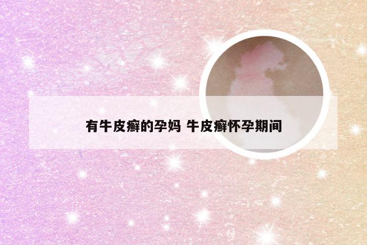 有牛皮癣的孕妈 牛皮癣怀孕期间