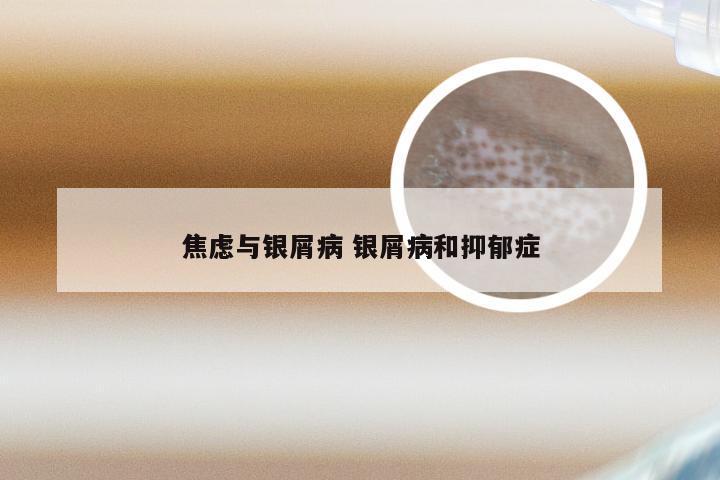 焦虑与银屑病 银屑病和抑郁症