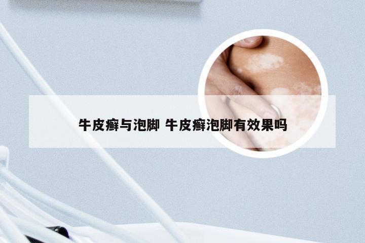 牛皮癣与泡脚 牛皮癣泡脚有效果吗