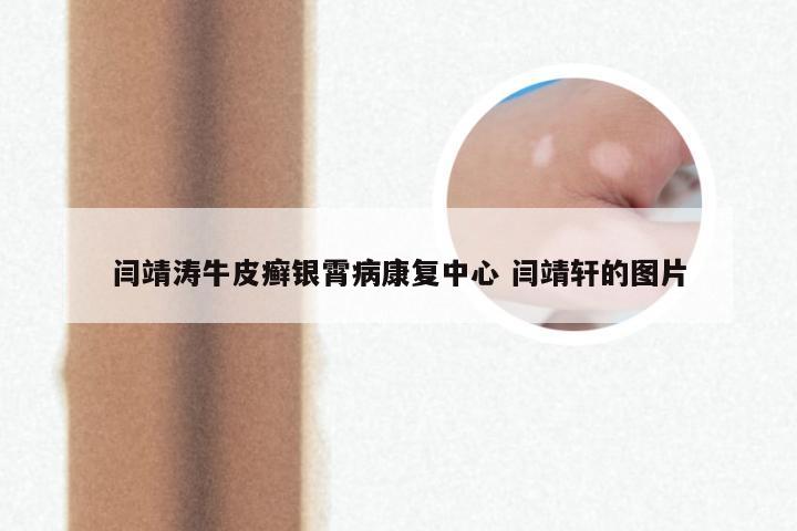 闫靖涛牛皮癣银霄病康复中心 闫靖轩的图片