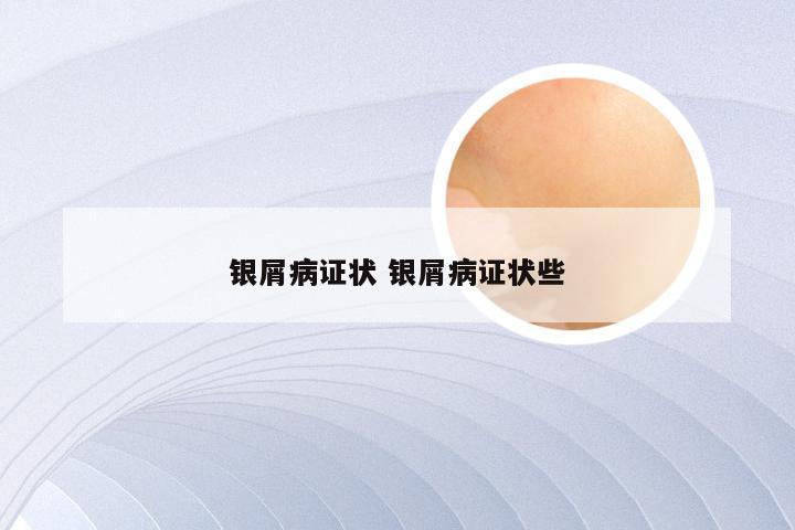 银屑病证状 银屑病证状些